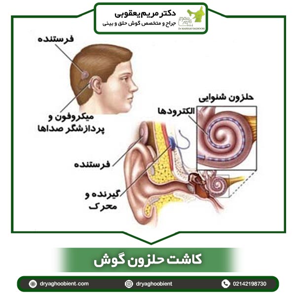 کاشت حلزون گوش _ دکتر یعقوبی