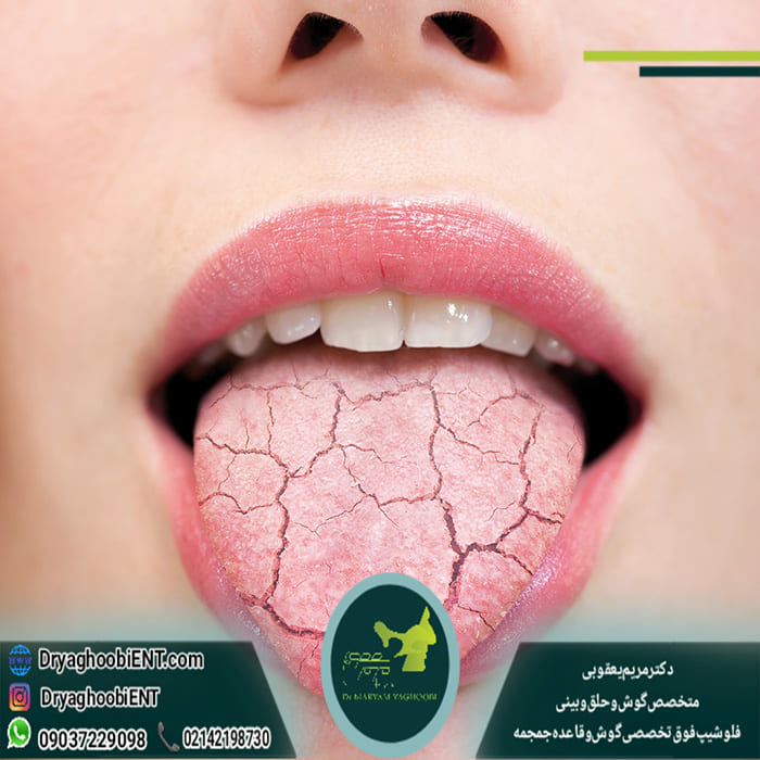 درمان خشکی دهان