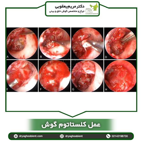 عمل کلستاتوم گوش _ دکتر یعقوبی
