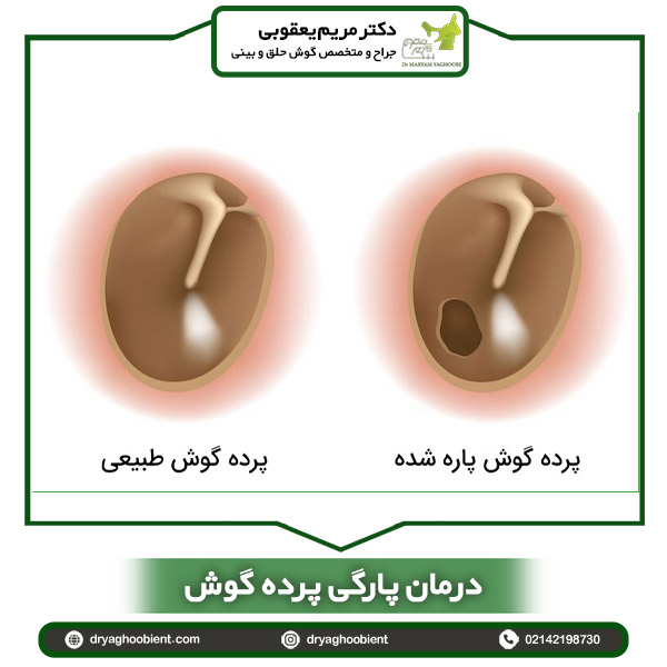 درمان پارگی پرده گوش _ دکتر مریم یعقوبی