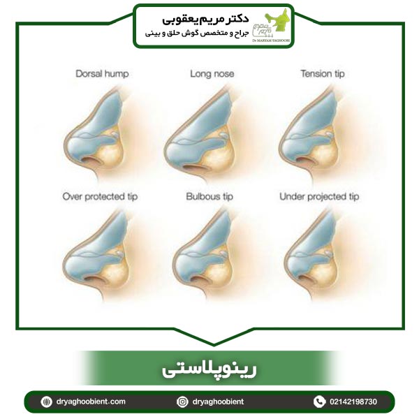 رینوپلاستی-دکتر مریم یعقوبی