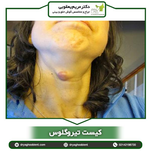 کیست تیروگلوس