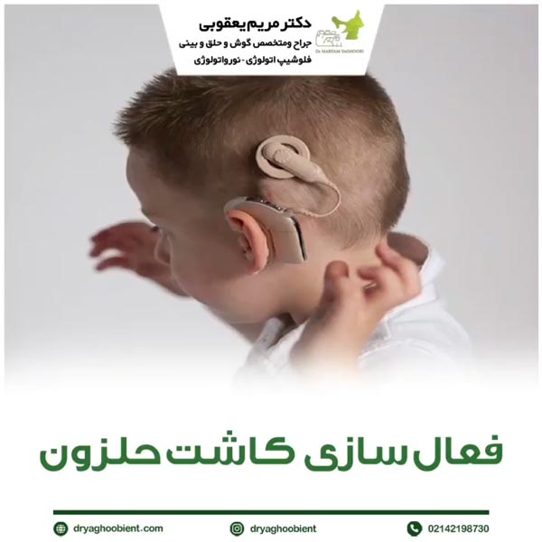 کاشت حلزونی گوش - دکتر مریم یعقوبی