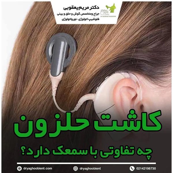 کاشت حلزون گوش - دکتر مریم یعقوبی 