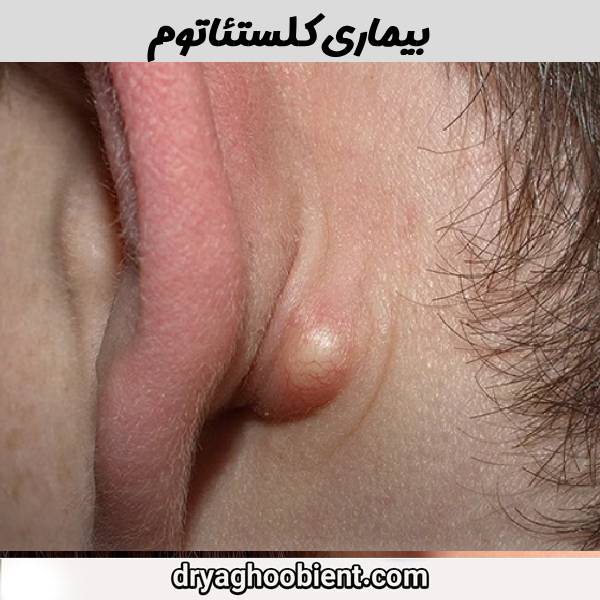 عکس بیماری کلستئاتوم