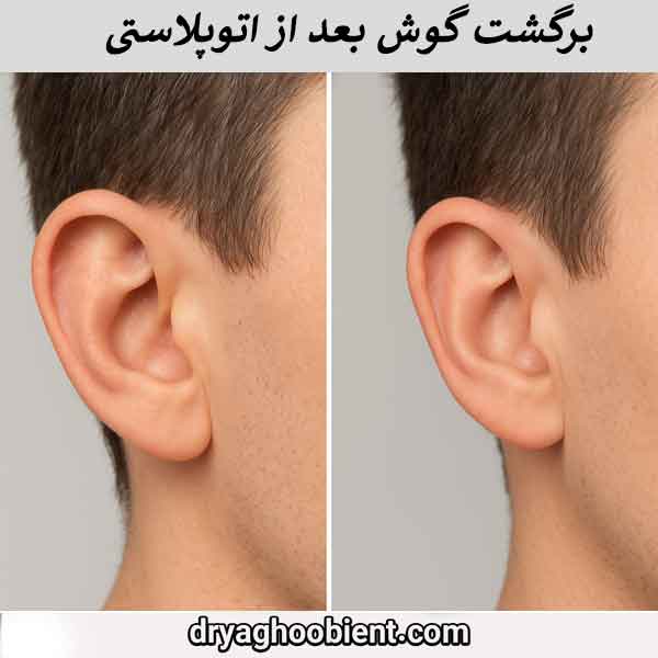 برگشت گوش بعد از اتوپلاستی