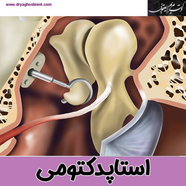 جراحی استاپدکتومی - دکتر مریم یعقوبی