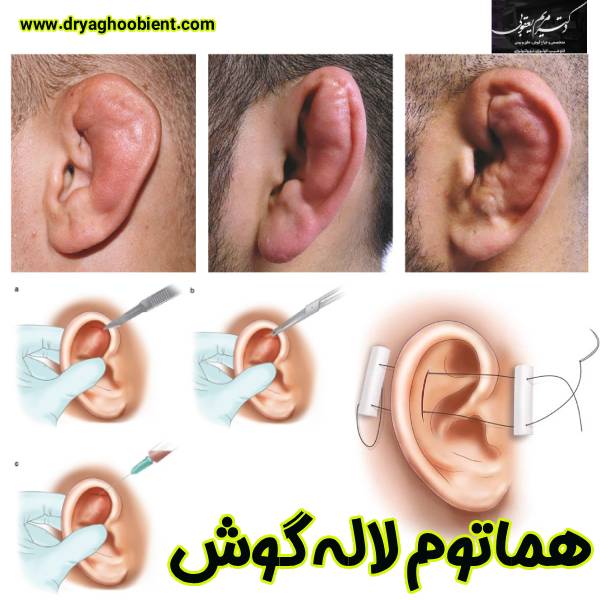 هماتوم لاله گوش - دکتر مریم یعقوبی