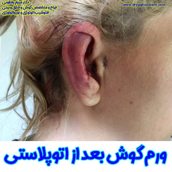 ورم گوش بعد از اتوپلاستی - دکتر مریم یعقوبی