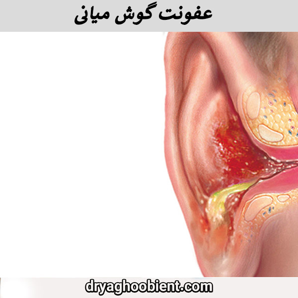 عفونت گوش میانی