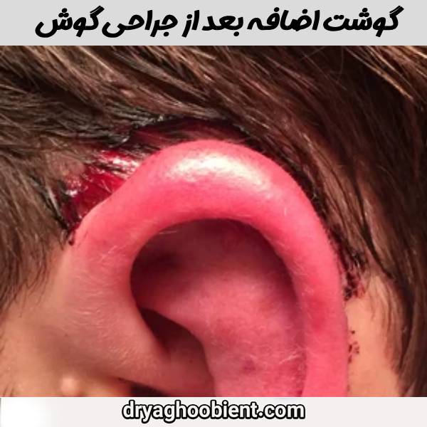 گوشت اضافه ببعد از جراحی گوش