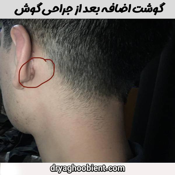 گوشت اضافه ببعد از جراحی گوش