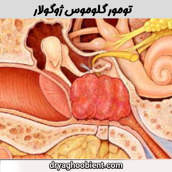 تومور گلوموس ژوگولار