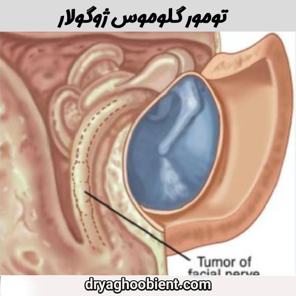 تومور گلوموس ژوگولار