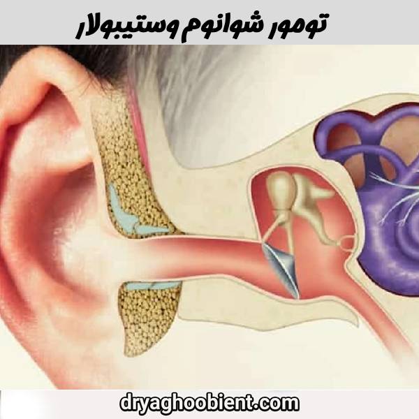 تومور شوانوم وستیبولار